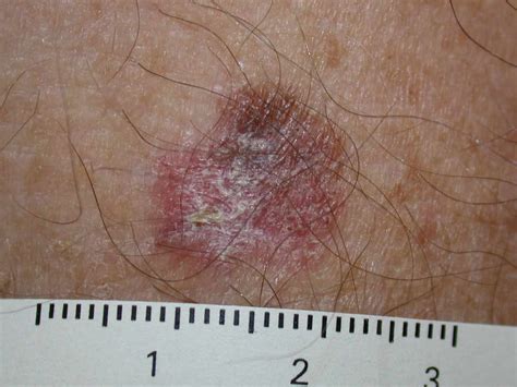 melanoma in situ dermnet